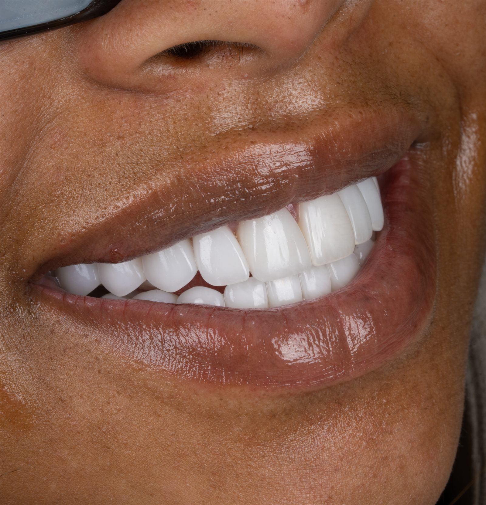 Full-Mouth — After