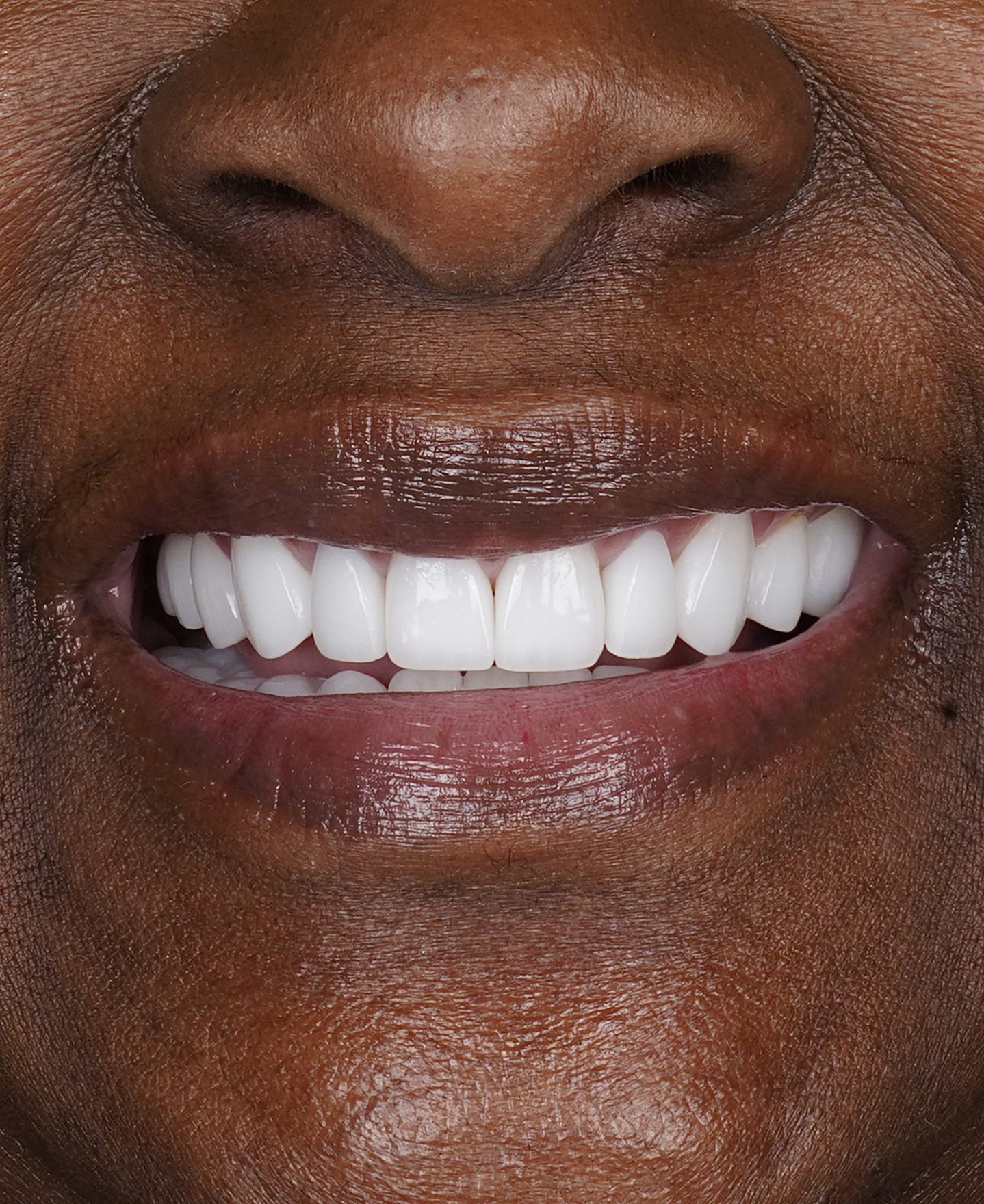 Smile Makeover — After