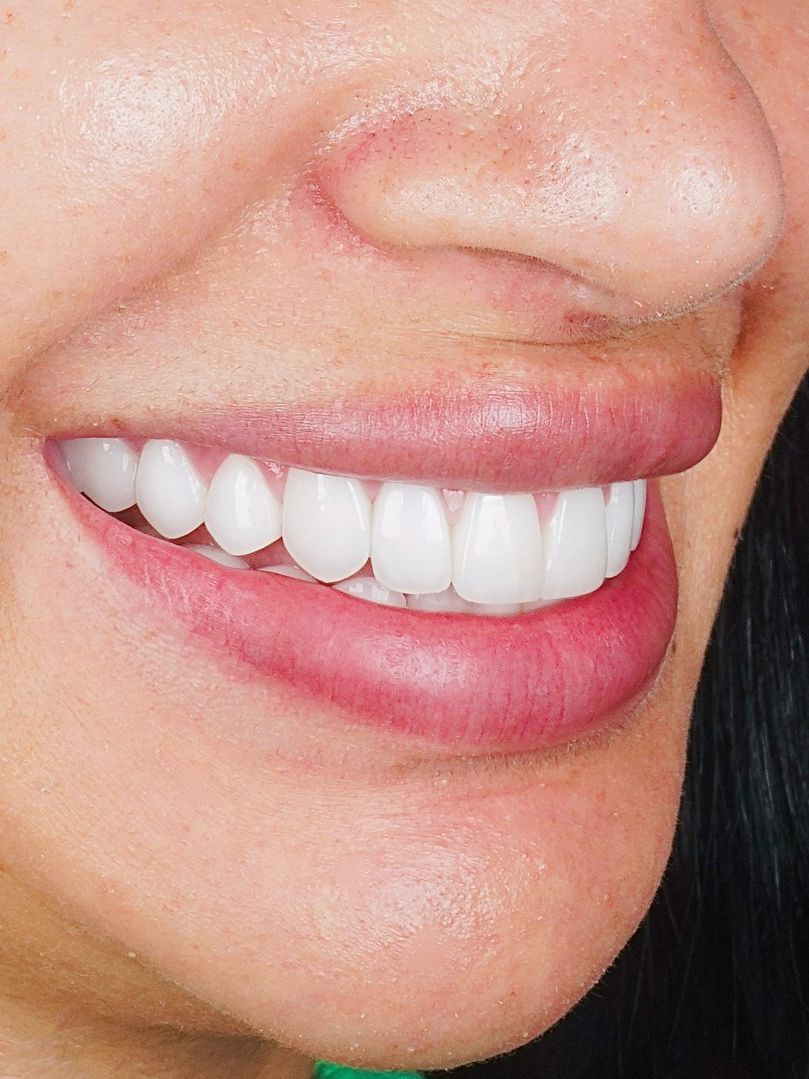 Original Case — Porcelain Veneers