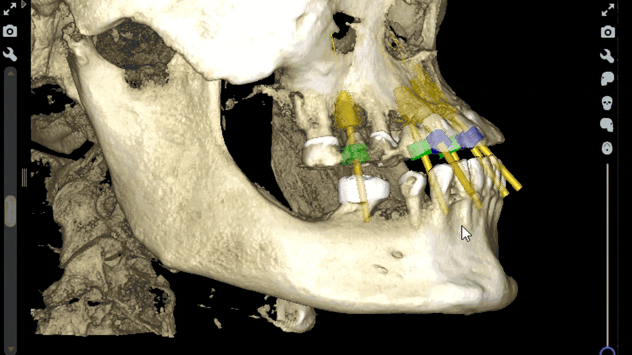 3D CT scan visualization of dental implant placement planning showing titanium posts and crown design in the upper jaw.