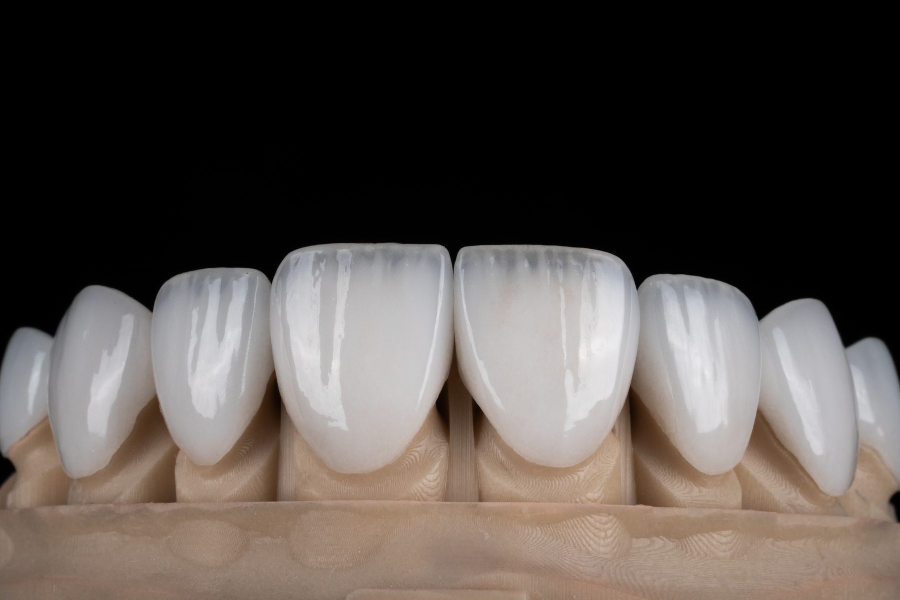 Close-up of a porcelain veneers smile finished at Rose Aesthetics — natural color, shape, and translucency.